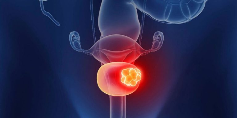 Bladder Cancer Symptoms: Early Warning Signs, Risk Factors