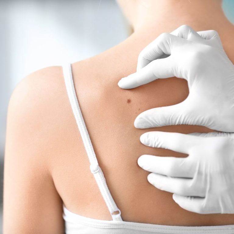 Recognizing Early Stage Melanoma Symptoms and Signs