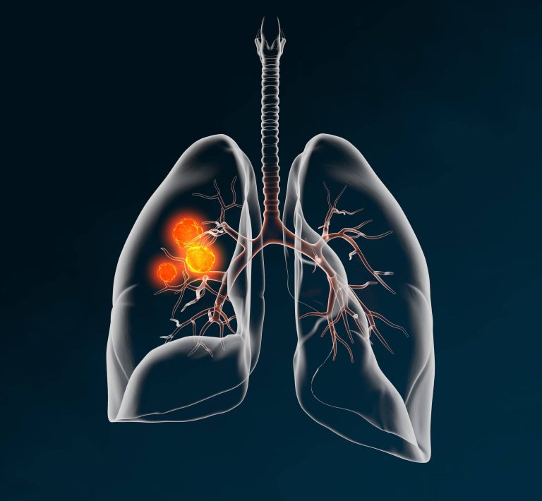 Understanding Lung Cancer Symptoms and Treatment Options