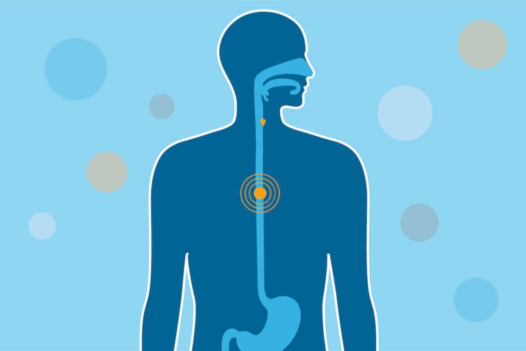 Treatment Options for Esophageal Cancer
